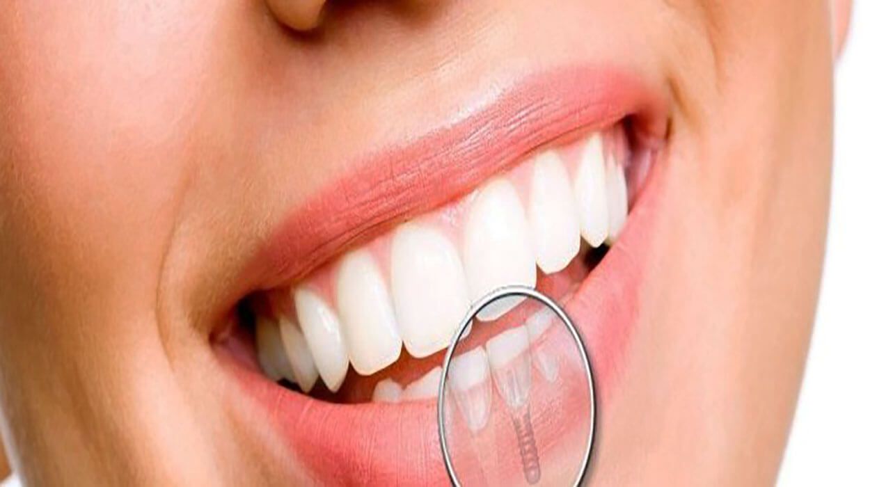 implante dental de carga rápida | implante mesmo dia