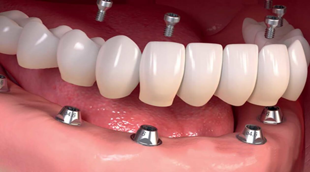 prótese dental | prótese dentária | prótese bucal